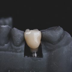 Implanty zębowe – Korzyści z implantów stomatologicznych